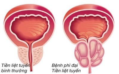 Biến chứng thường gặp sau khi mổ u xơ tiền liệt tuyến