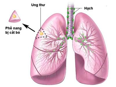 Ung thư phổi: Nguyên nhân, yếu tố nguy cơ gây bệnh và điều trị