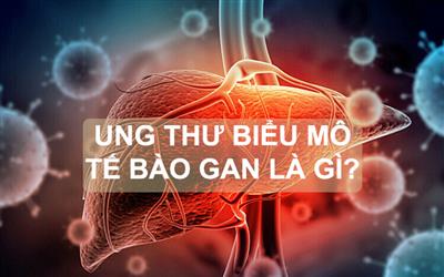 Ung thư biểu mô tế bào gan là gì?