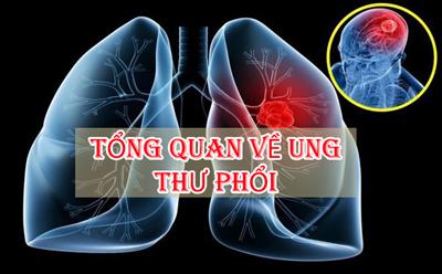 Nguyên nhân gây ung thư phổi, triệu chứng, chẩn đoán và điều trị